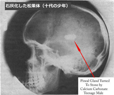 pineal-gland-calcification